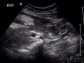 成人能得肠套叠吗视频,罕见但需警惕的肠道疾病